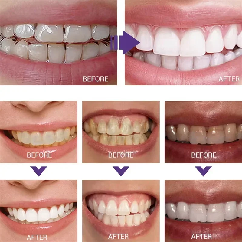 Zahnreinigung, Aufhellung, Zah – Teeth Whitening Korea Bewertung und Preis