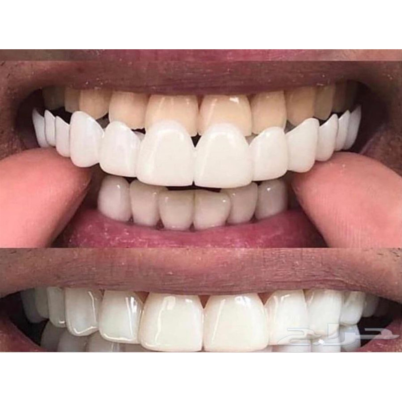Weiche Silikon Gel Dental Oral – Teeth Whitening Moulds Bewertung und Preis