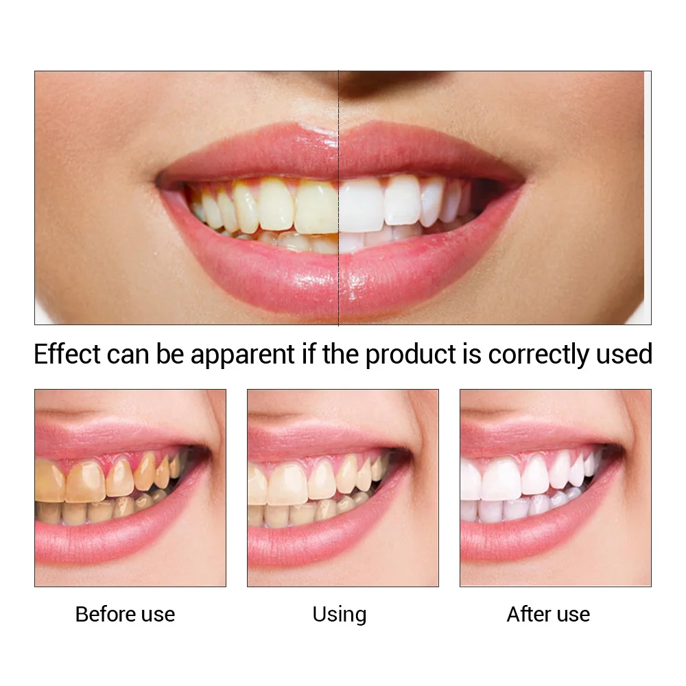 FTEENPLY Zahnaufhellung Essenz – Teeth Whitening Best Bewertung und Preis