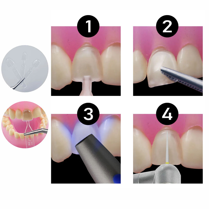 32-teiliges Set Komposit-Harzf – Teeth Whitening Moulds Bewertung und Preis