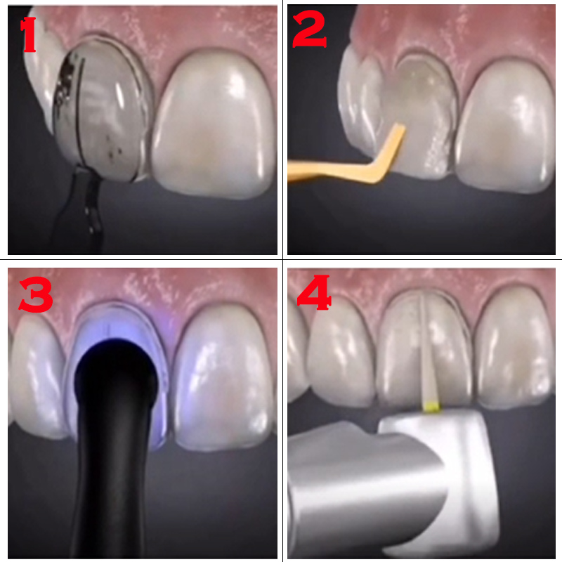 32-teiliges Dental-Veneer-Form – Teeth Whitening Moulds Bewertung und Preis
