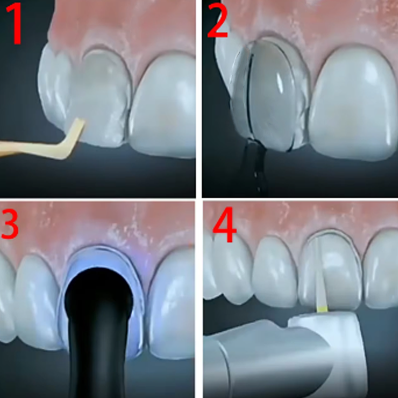 32 teile/schachtel Dental Furn – Teeth Whitening Moulds Bewertung und Preis